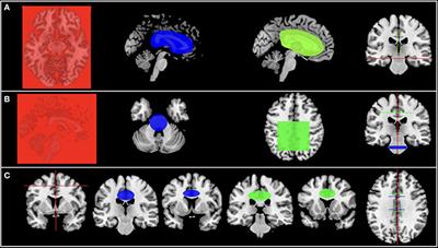 Is Diffusion Tensor Imaging a Good Biomarker for Early Parkinson's Disease?